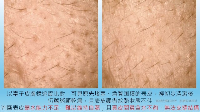 受訪文章》皮膚敏感又乾燥！要補水還是鎖水？宋奉宜醫師：皮膚乾