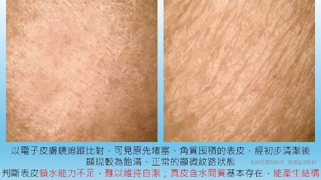 受訪文章》皮膚敏感又乾燥！要補水還是鎖水？宋奉宜醫師：皮膚乾